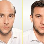 Hair transplant before and after preview showing a fuller hairline with an AI hair transplant simulator